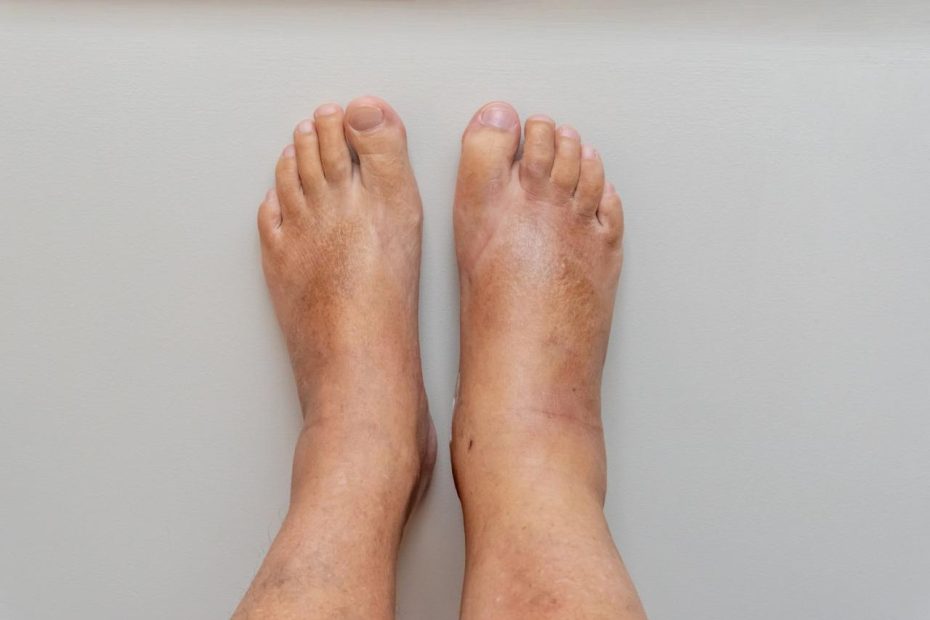 Are Swollen Feet A Sign Of Heart Failure?