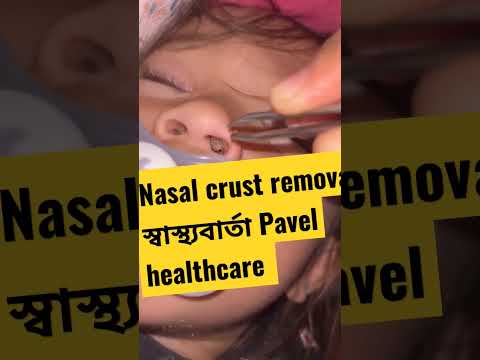 Nasal crust Removal