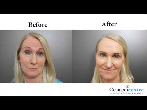 No Trace Face Treatment Before and After By Cosmedicentre